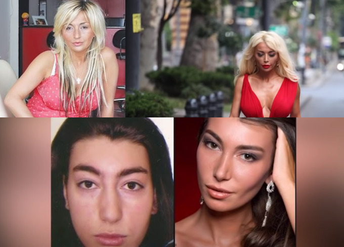 როგორ გამოიყურებიან  15 ცნობილი ქართველი სელებრითი, რომელთაც პლასტიკურ ქირურგიას მიმართეს – ადრე და ახლა